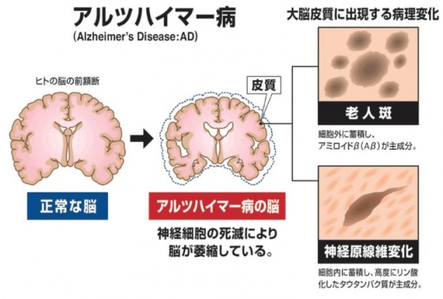 認知症予備軍が血液検査でわかる時代が、く~~る~~~!!!のアイキャッチ画像